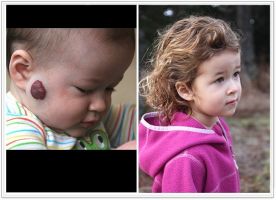 (a) Patient with right cheek hemangioma, unresponsive to oral propranolol (b) 20 months status post surgery and laser therapy